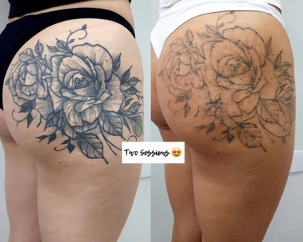 Tattoo Removal Institute showcase image